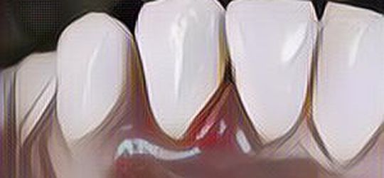 Gusi Belakangmu Bengkak dan Sakit Saat Menelan? Bisa Jadi Kamu Menderita Gingivitis, Kenali Gejalanya!