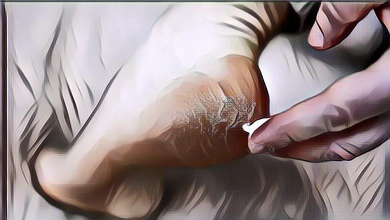 Jangan Tunggu Sampai Luka! Berikut Tips Mengatasi Tumit Kaki yang Pecah-Pecah