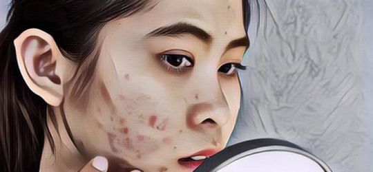 Heboh, Wanita Ini Pakai Obat Betadine untuk Jerawat: Emang Aman?