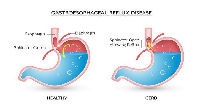 Tips Atasi Asam Lambung yang Naik