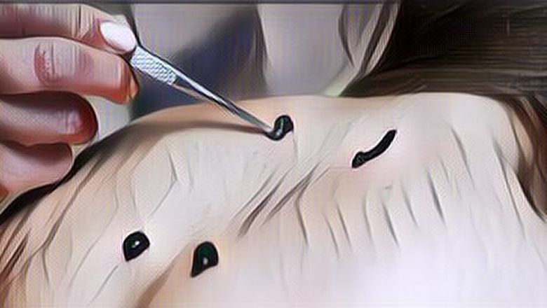 Hebat Banget! Ini Dia 5 Manfaat Terapi Lintah untuk Kesehatan