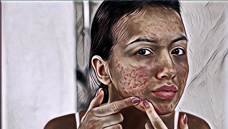 Bahan-Bahan Alami Ampuh Atasi Jerawat Tapi Jarang Diketahui Orang