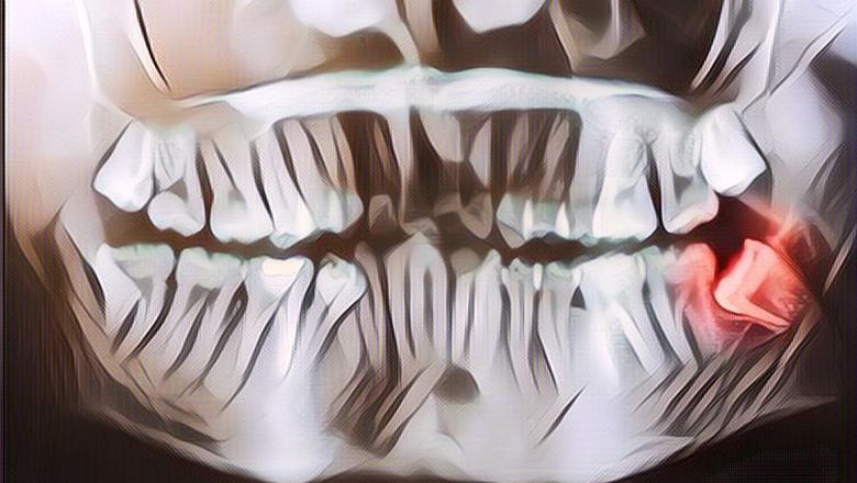 Mengenal Apa Itu Impaksi Gigi dan Apa yang Harus Dilakukan untuk Mengatasinya