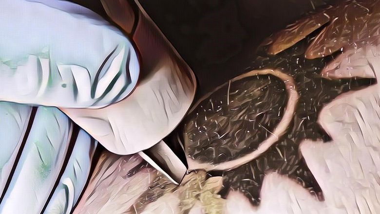 Pria Ini Terkena Tetanus Setelah Menghapus Tato, Bagaimana Cara yang Aman?