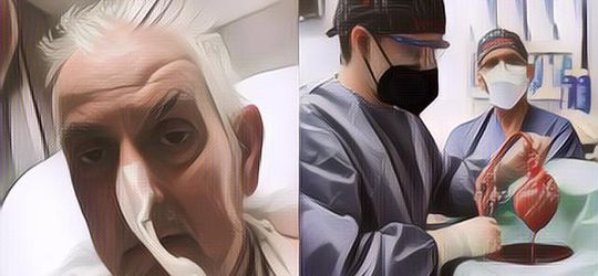 Hanya Bertahan 2 Bulan, Pasien Penerima Transplantasi Jantung Babi Pertama di Dunia Meninggal, Gini Kondisi Terakhirnya