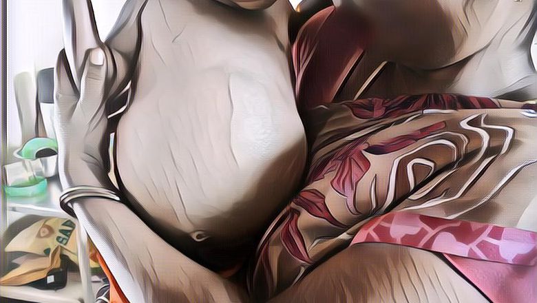 Ngeri! Wanita Ini Punya Kembaran yang Hidup di Dalam Tubuhnya