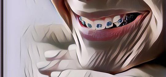 Bye-Bye Behel! Ini Nih 5 Cara Merapikan Gigi Agar Tertata Cantik