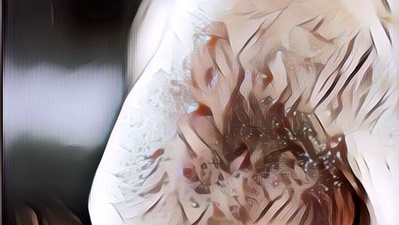 Bebas Jerawat dan Komedo, Begini Lho Cara Mengatasi Pori-Pori Tersumbat