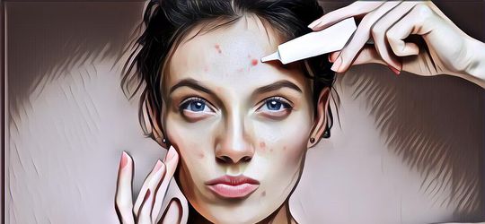 5 Cara Ampuh Mengatasi Jerawat di Area T-Zone