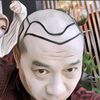 Coba Pikir-pikir Dulu, Ini Efek Samping Lakukan Transplantasi Rambut