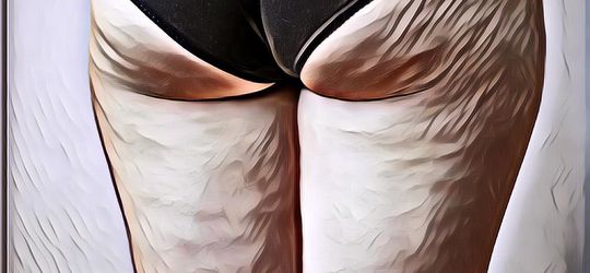 Cara Menghilangkan Selulit Secara Alami, Tanpa Krim atau Obat tapi Ampuh!