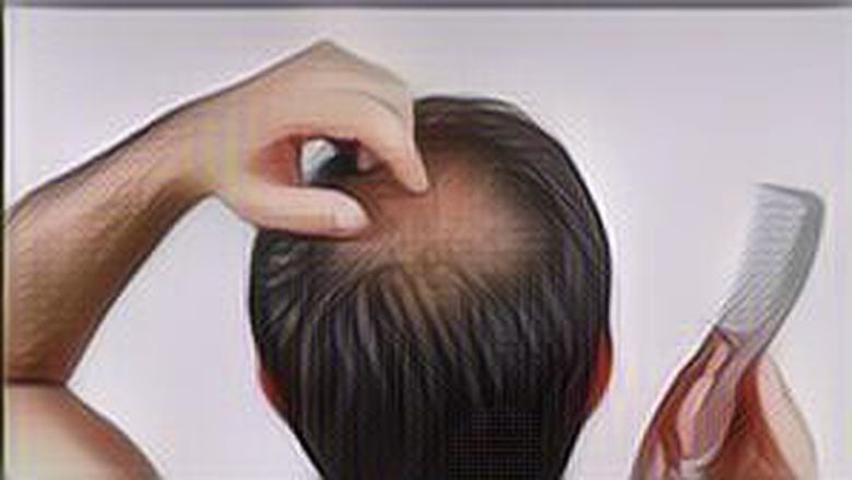 Masih Bisa Diusahakan, Coba 8 Cara Menumbuhkan Rambut dengan Natural Ini Jika Kamu Alami Kebotakan