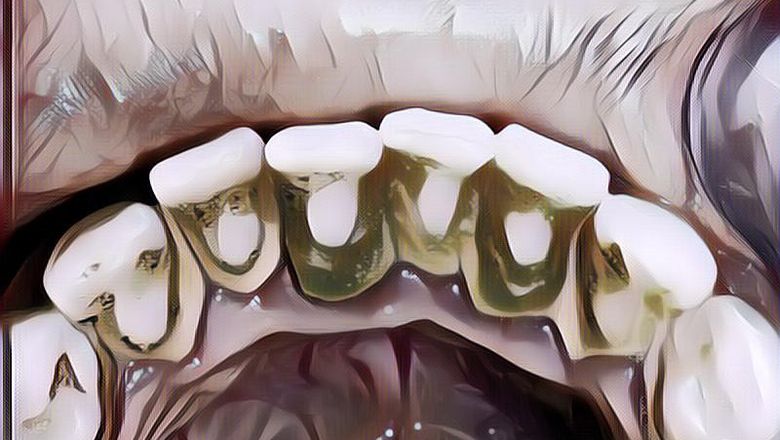 Cara Menghilangkan Karang Gigi yang Sudah Mengeras, Solutif Banget