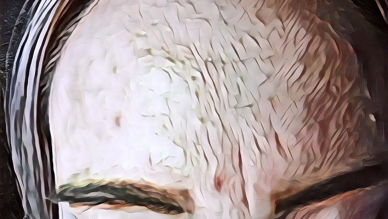 Cara Menghilangkan Bruntusan Di Dahi Pake Herbal , Murah Meriah Aman