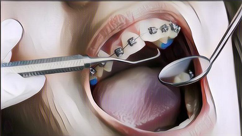 Begini Cara Merawat Gigi Yang Dipasangin Behel~