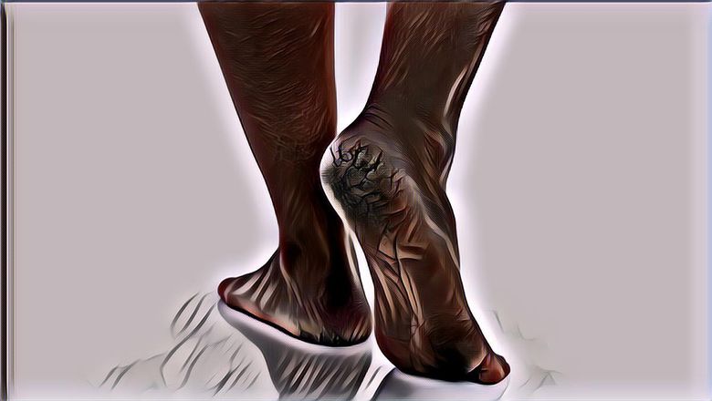 Bisa Dilakukan di Rumah, Ini 4 Cara Mengatasi Tumit Pecah-Pecah