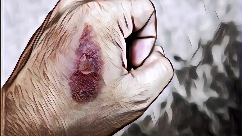 Begini Cara Merawat Luka Bakar Secara Tepat