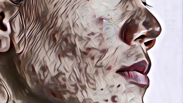 Awas, 5 Kebiasaan Ini adalah Hal yang Paling Sering Bikin Wajah Breakout dan Masih Sering Dilakukan!