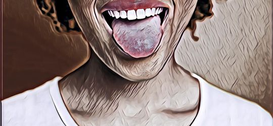 Covid Tongue, Sariawan Juga Bisa Jadi gejala Corona Ini Bedanya  Dengan yang Biasa