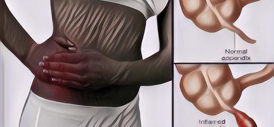 Segala Hal yang Perlu Kamu Tahu tentang Penyakit Usus Buntu