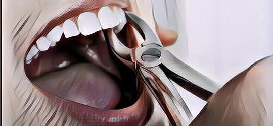 Benarkah Langsung Olahraga Setelah Cabut Gigi Bisa Menyebabkan Pendarahan Hebat? Begini Penjelasannya!