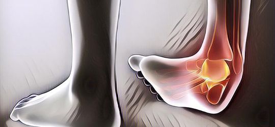 Tips Mengatasi Pergelangan Kaki yang Keseleo