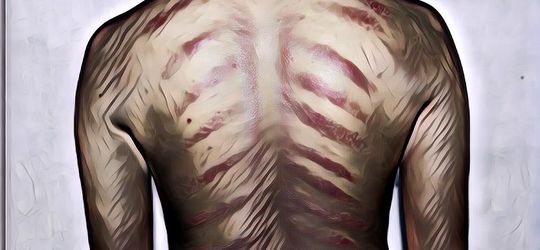 Kerokan Berbahaya Bagi Tubuh, Mitos atau Fakta?