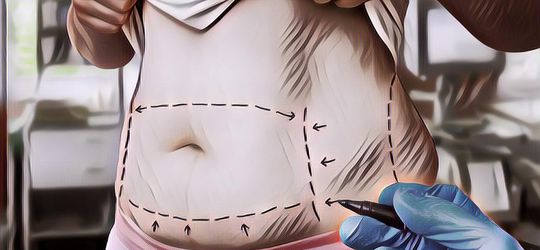 4 Fakta Tentang Sedot Lemak yang Perempuan Harus Tahu, Bikin Penasaran Deh!