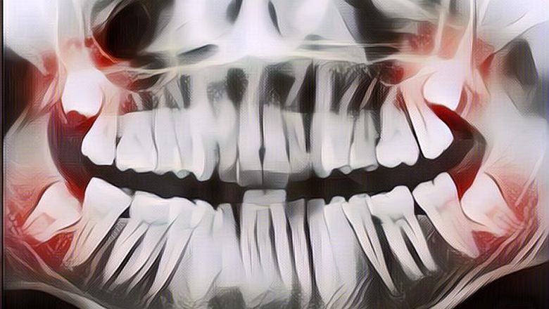 Mengenal Fungsi Gigi Bungsu yang Kadang Masih Tumbuh Ketika Kita Dewasa, Kenapa Seringkali Harus Dicabut?