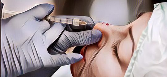 Mengenal Filler Hidung, Treatment Kecantikan yang Dilakukan Kekeyi