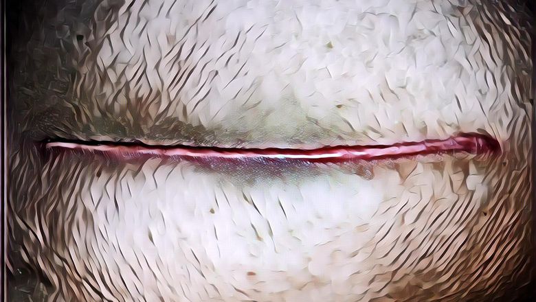 Penyebab dan Cara Menghilangkan Keloid atau Bekas Luka yang Menonjol