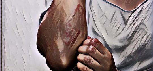 Gejala, Penyebab, dan Cara Mengobati Penyakit Kulit Prurigo atau Darah Manis