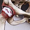 5 Gejala Osteoarthritis yang Paling Umum