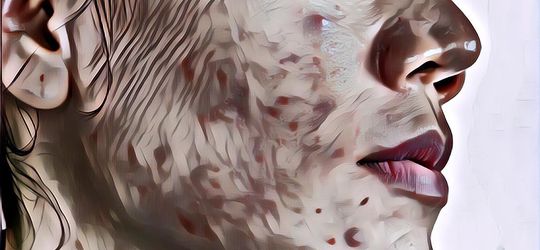 Jerawat Bandel Di Wajah Susah Ilang? Jangan-Jangan Kamu terlalu Banyak Memakan Ini