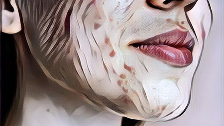 3 Cara Alami dan Aman Hilangkan Bekas Jerawat, Bisa Dilakukan di Rumah