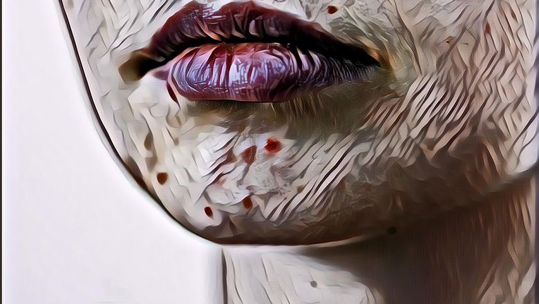 Bingung dengan Kondisi Jerawat Hormon Seperti Apa? Begini Ciri-Cirinya