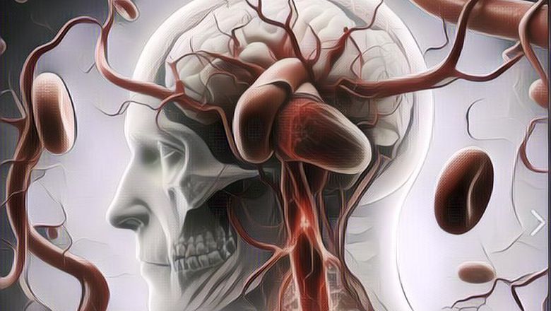 Penjelasan Soal Aneurisma Otak, yang Pernah Menyerang Seorang Pria di Surabaya Ketika Bercinta