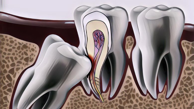 Mengenal Apa Itu Impaksi Gigi dan Cara Mencegahnya