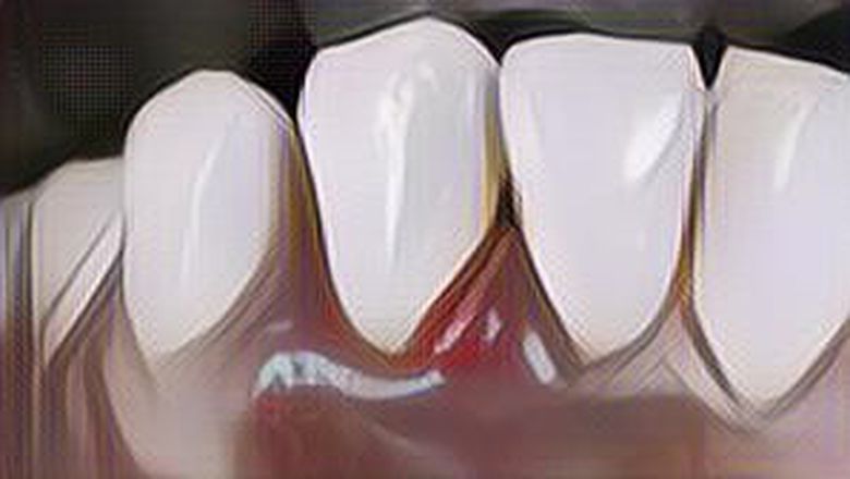 Gusi Belakangmu Bengkak dan Sakit Saat Menelan? Bisa Jadi Kamu Menderita Gingivitis, Kenali Gejalanya!