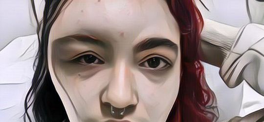 Miris, Wanita Ini Alami Iritasi Cat Rambut, Wajahnya Jadi Bengkak Sebelah