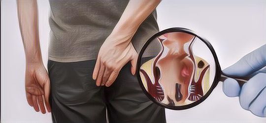 Gejala dan Penyebab Umum Ambeien atau Wasir, Kapan Harus ke Dokter?