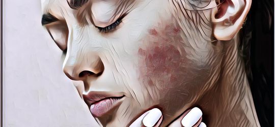 Bikin Makin PeDe, Ini 5 Rekomendasi Krim Penghilang Bekas Jerawat