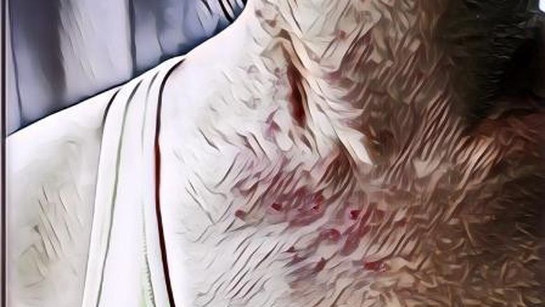 Gejala COVID-19 yang Gak Biasa Bahkan Kamu Bisa Gak Sadar