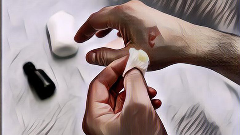 Bukan Pakai Odol! Ini Cara Mengobati Luka Bakar Ringan yang Benar di Rumah