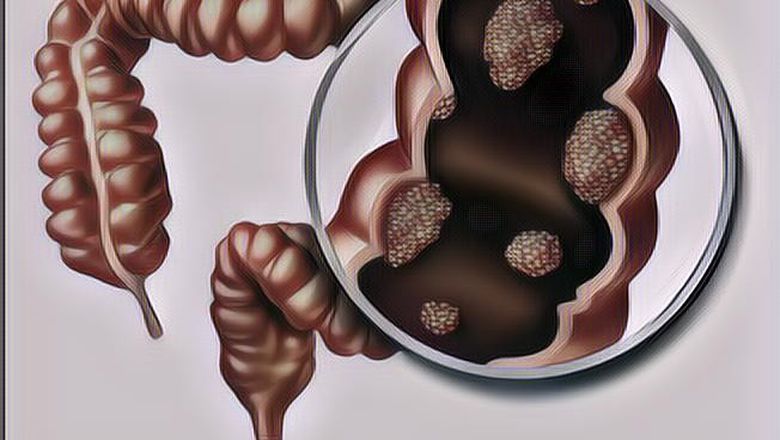 Kanker Kolon adalah Kanker yang Tumbuh di Permukaan Usus Besar atau Rektum, Berikut Ini Gejalanya