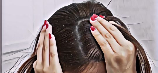 Ternyata, Ada 4 Jenis Ketombe di Rambut yang Perlu Diketahui