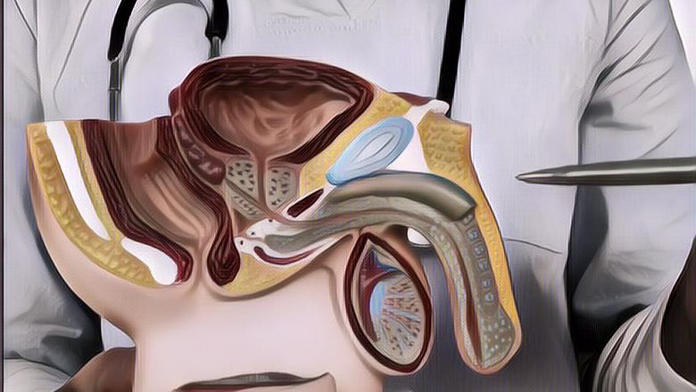 Mengenal Apa Itu Kontrasepsi Vasektomi yang Bisa Jadi Pilihan KB Ideal Bagi Pasutri
