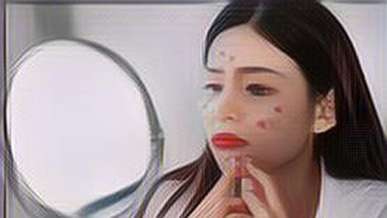 5 Tips Mencegah Jerawat di Area T-Zone Muncul