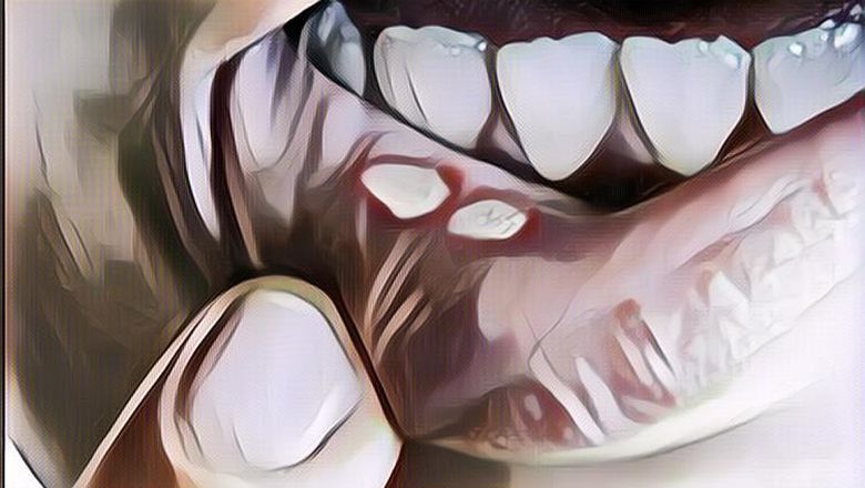 Penyakit Sejuta Umat, Sariawan Bisa Jadi Tanda Penyakit Berbahaya Lho!