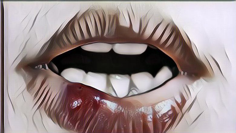 Cara Menghilangkan Sariawan dengan Cepat, Alami dan Aman Terkendali